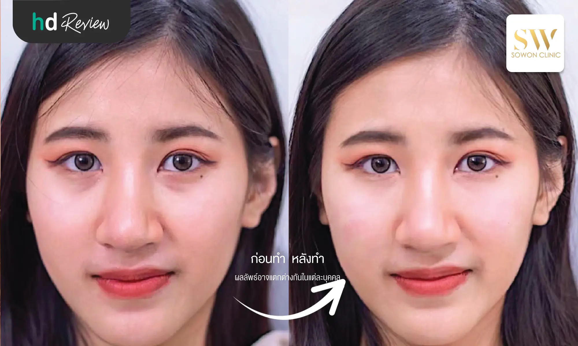 review before after filler under eye sowon clinic hero