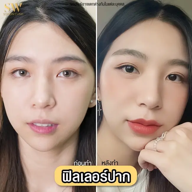 รีวิวฉีดฟิลเลอร์ปาก ที่ Sowon Clinic รูป 1