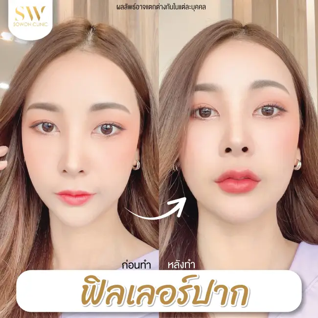 รีวิวฉีดฟิลเลอร์ปาก ที่ Sowon Clinic รูป 2