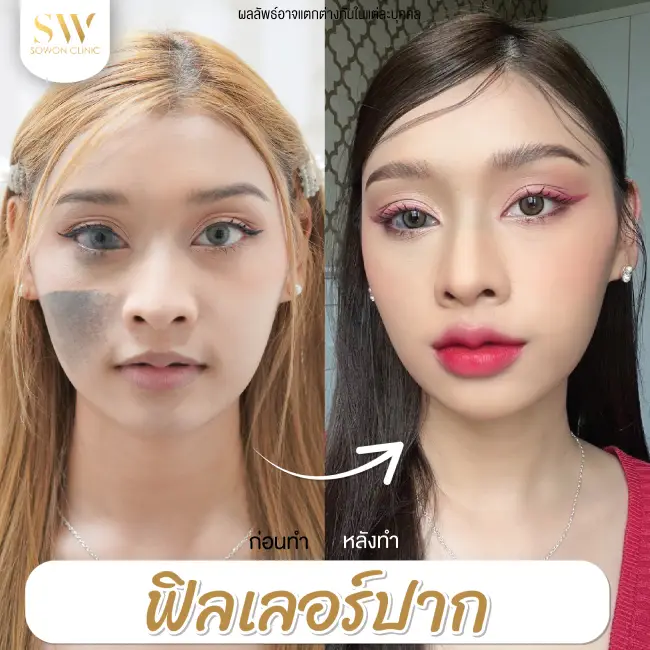 รีวิวฉีดฟิลเลอร์ปาก ที่ Sowon Clinic รูป 3