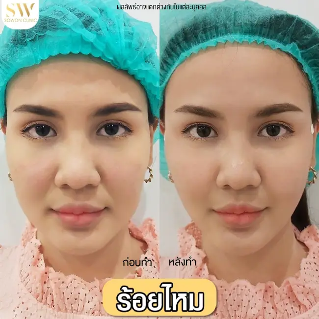 รีวิวโปรแกรมร้อยไหมยกกระชับ ที่ Sowon Clinic รูปที่ 2