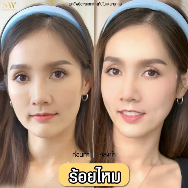 รีวิวโปรแกรมร้อยไหมยกกระชับ ที่ Sowon Clinic รูปที่ 3