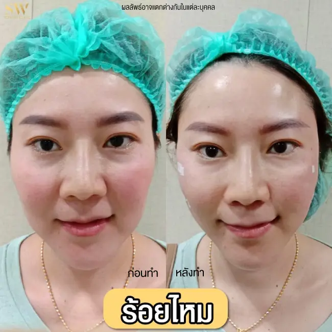 รีวิวโปรแกรมร้อยไหมยกกระชับ ที่ Sowon Clinic รูปที่ 4