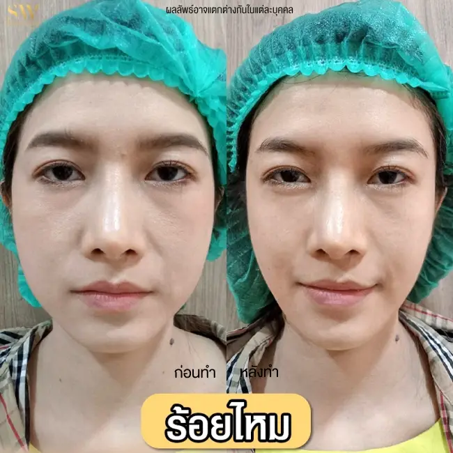 รีวิวโปรแกรมร้อยไหมยกกระชับ ที่ Sowon Clinic รูปที่ 5