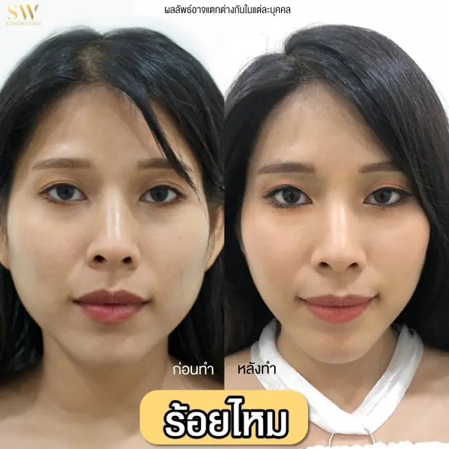 รีวิวโปรแกรมร้อยไหมยกกระชับ ที่ Sowon Clinic รูปที่ 6