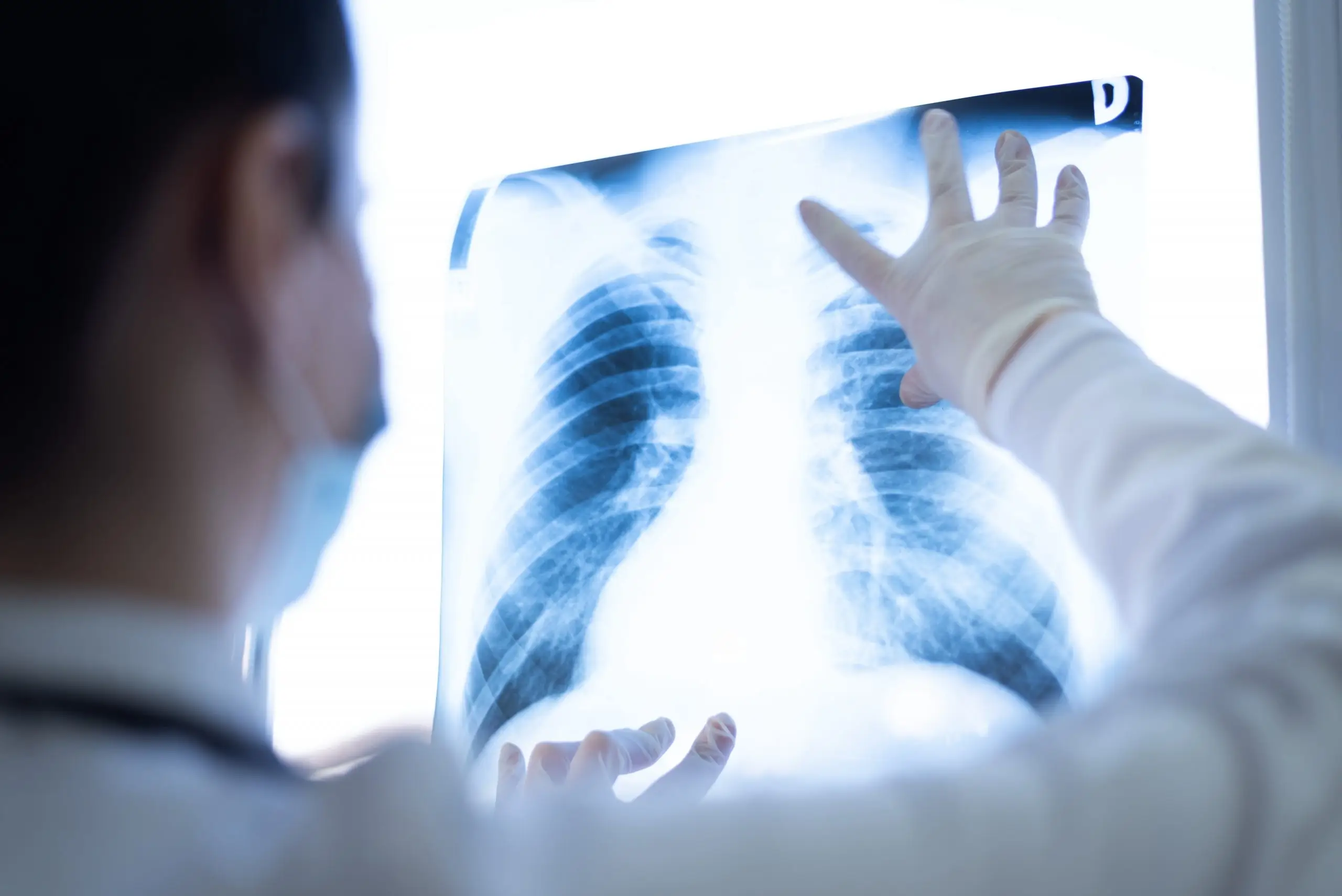 screening for lung cancer screening when to get check scaled