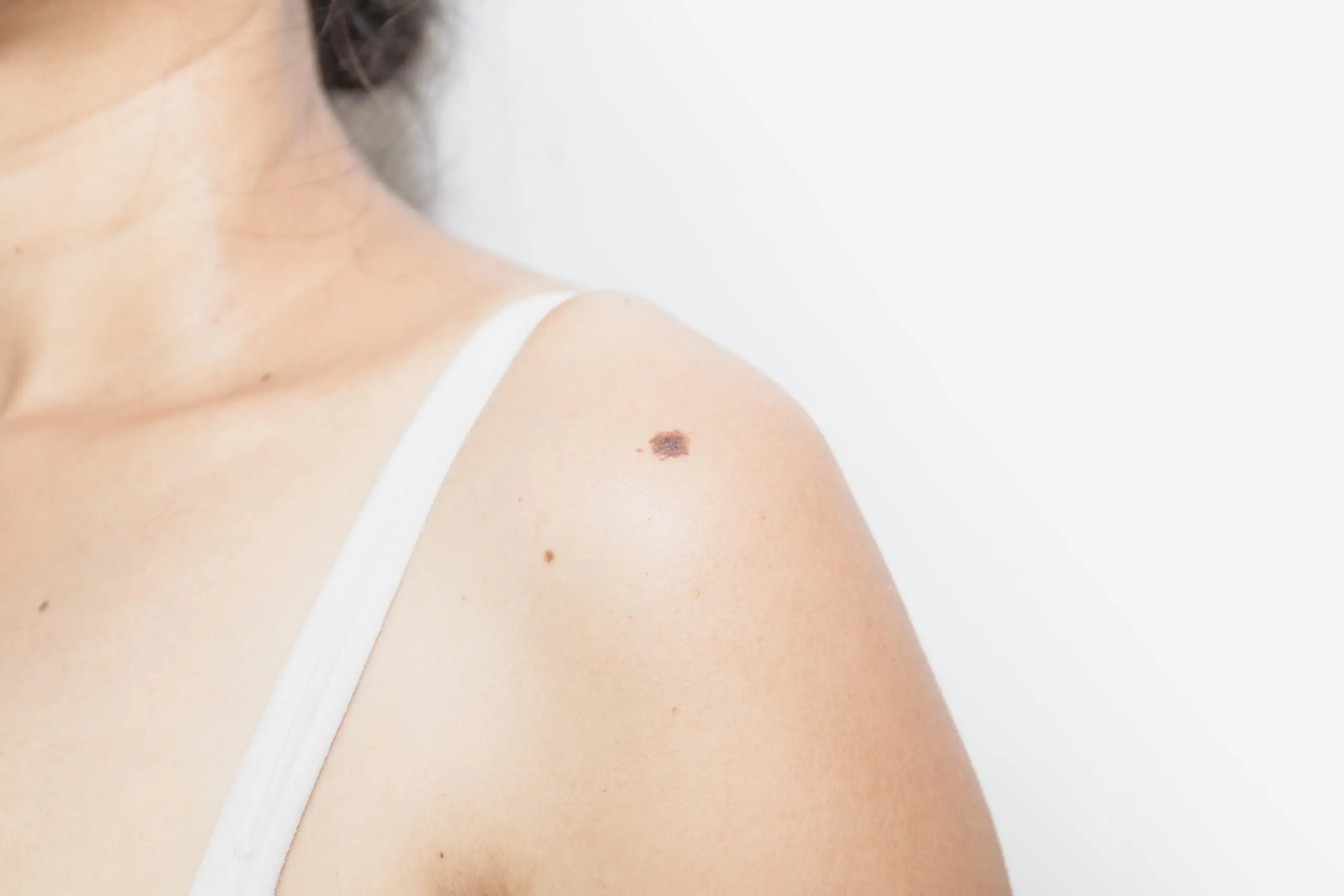 skin moles types and mole removal disease definition scaled