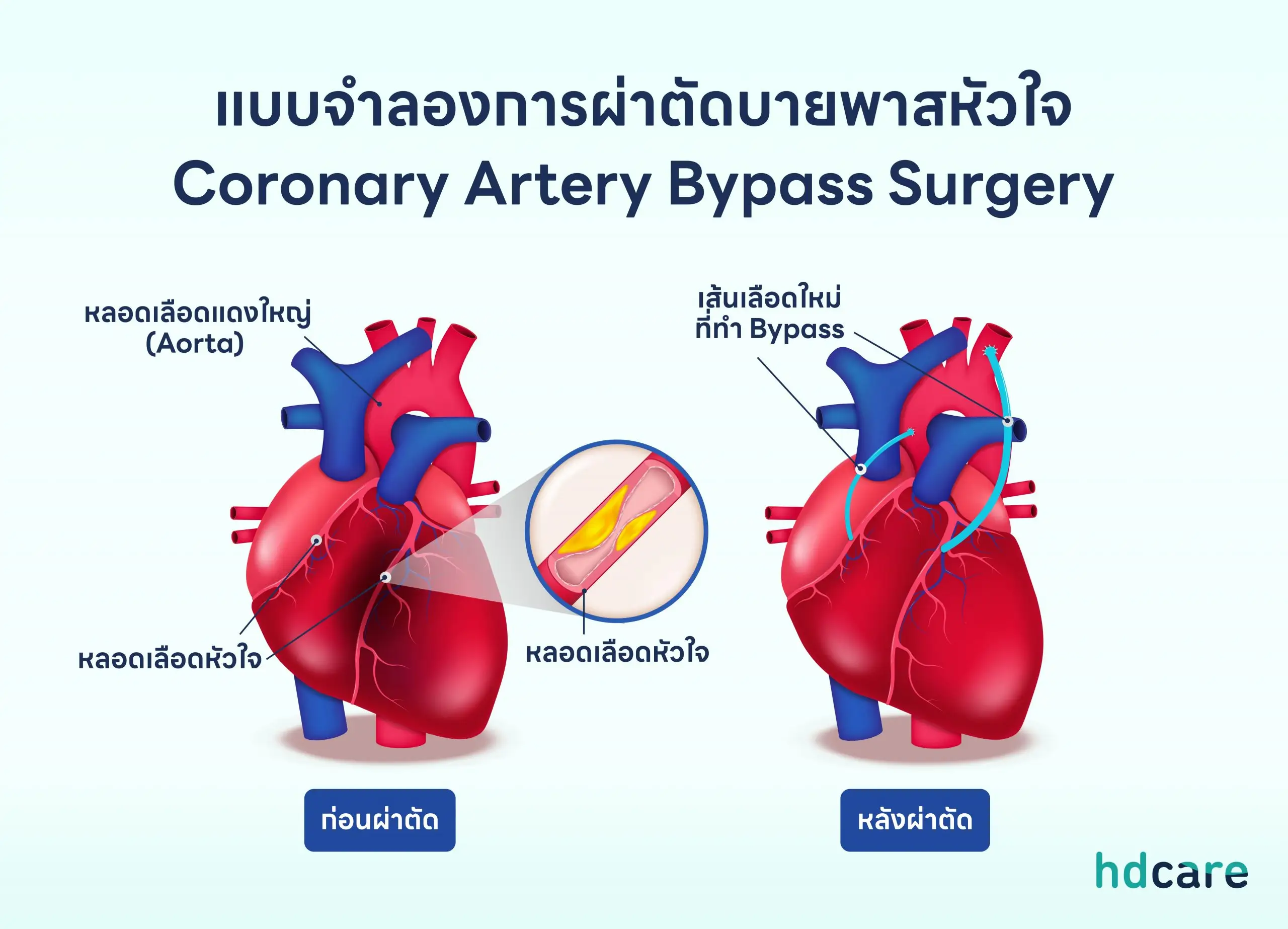 แบบจำลองการผ่าตัดบายพาสหัวใจ