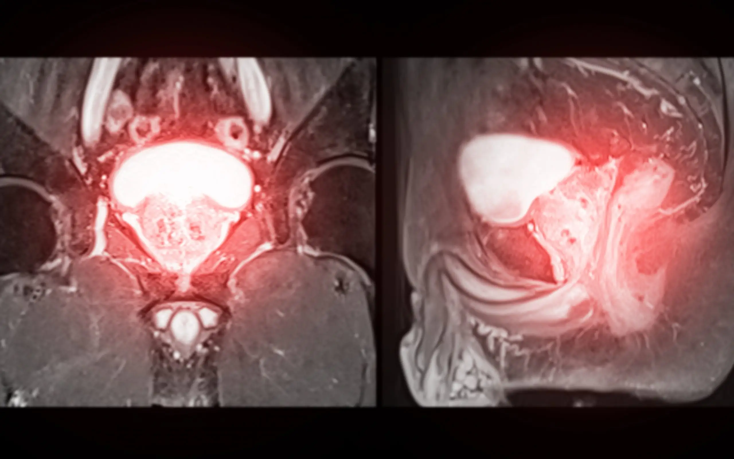 bph treatment comparison scaled