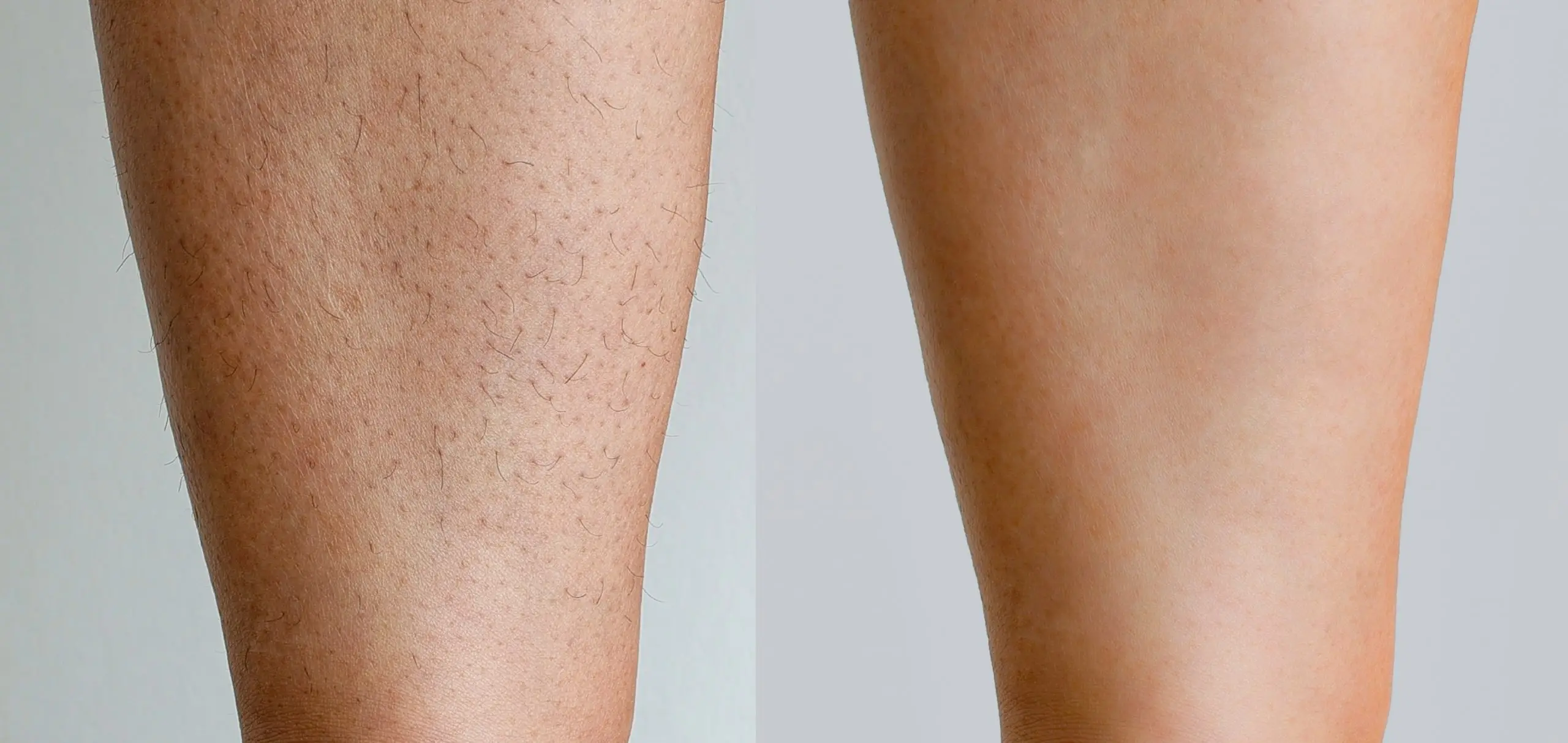 dos and donts laser hair removal aftercare treatment how to scaled