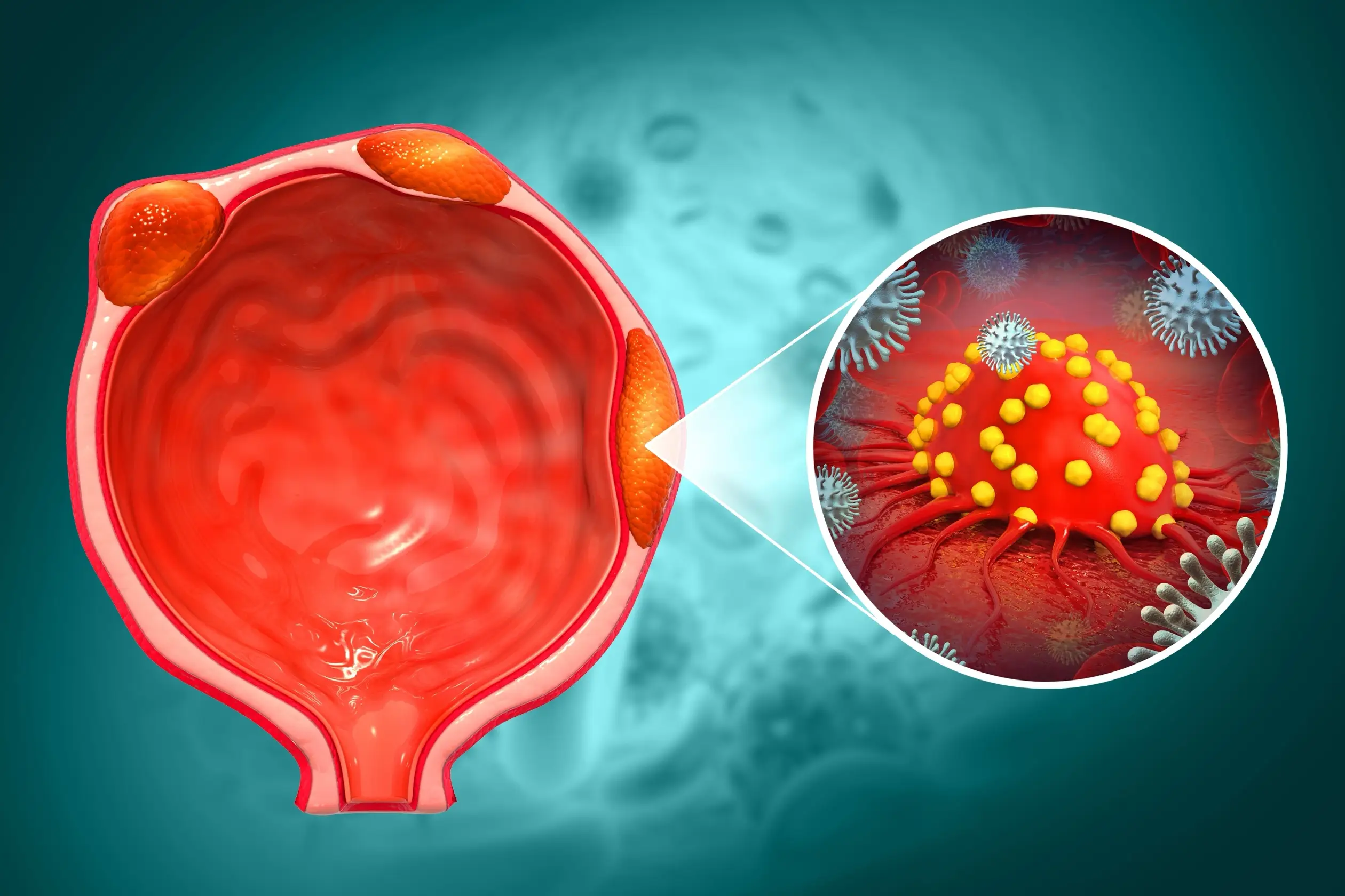 prostate cancer treatment comparison