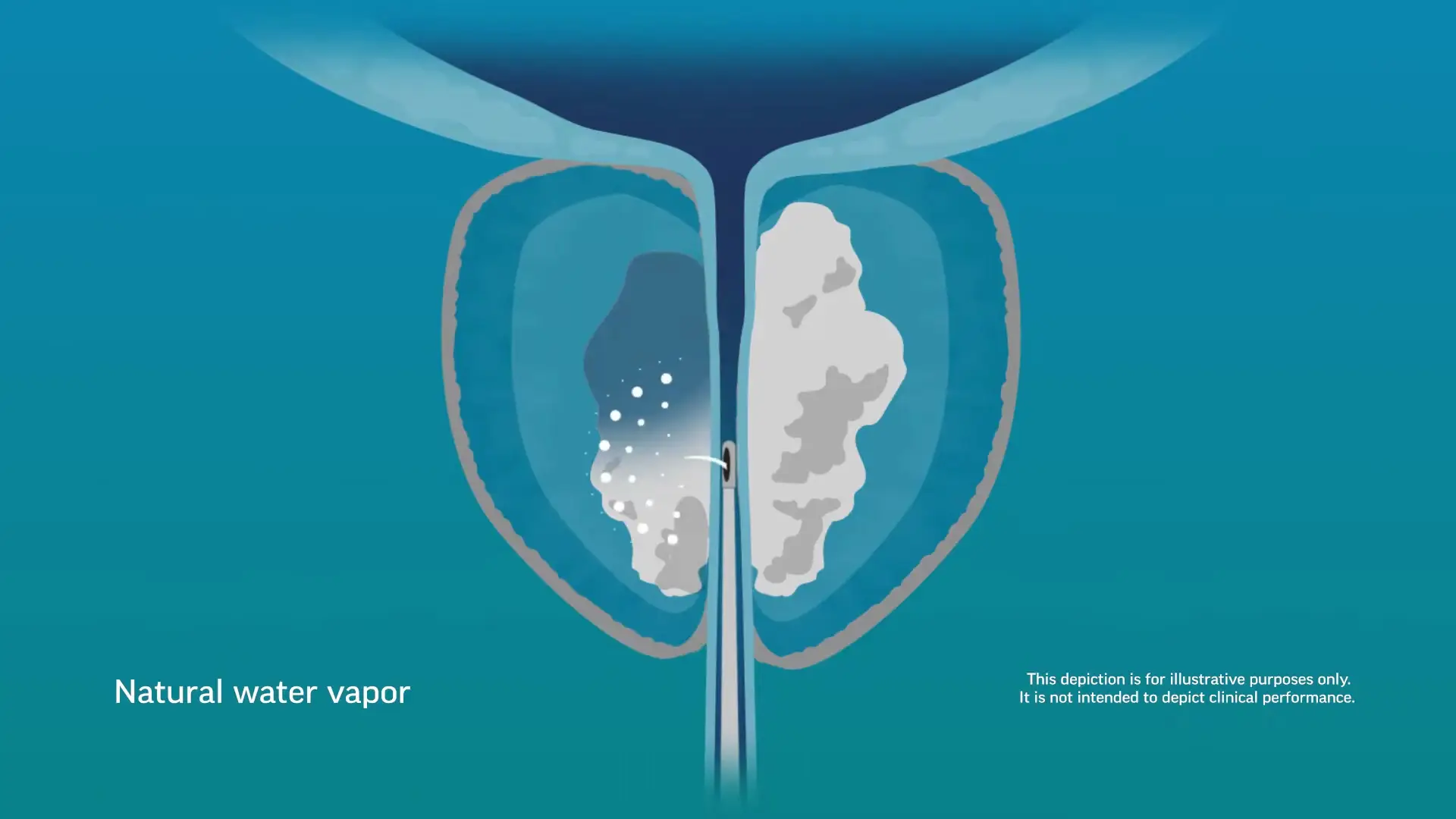 rezum treatment process