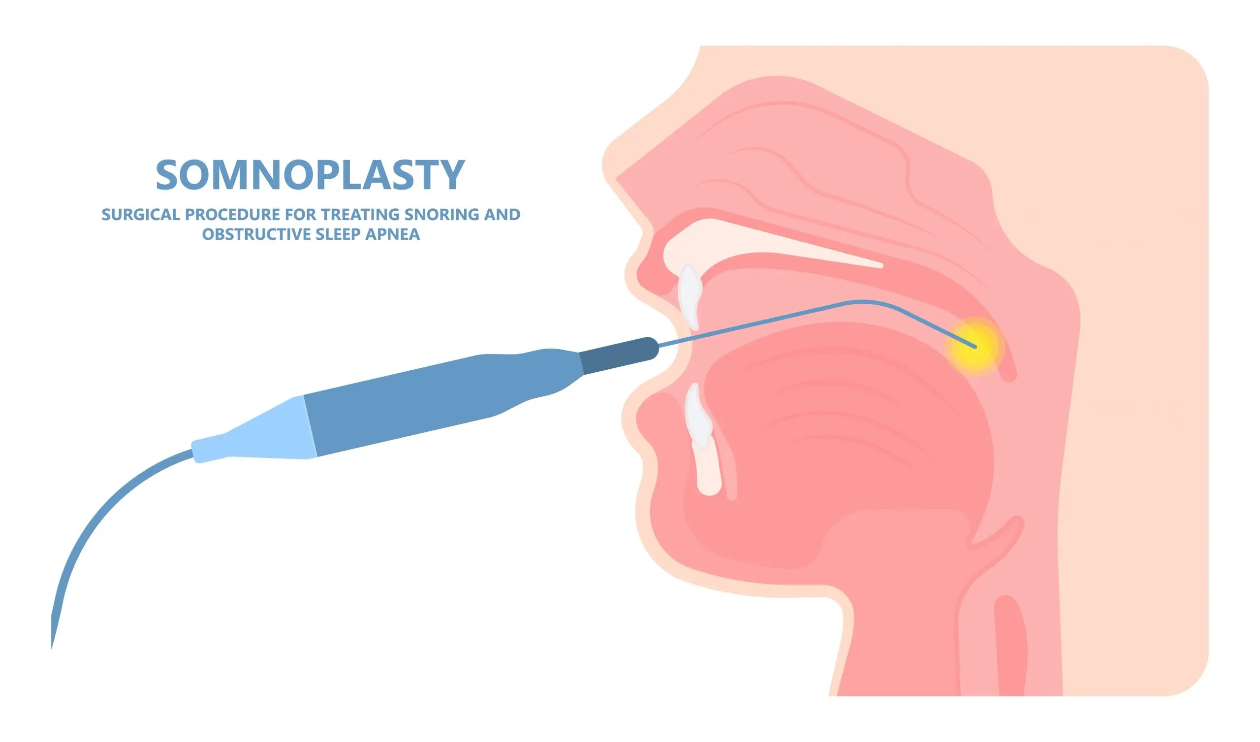 snoring rf treatment process scaled