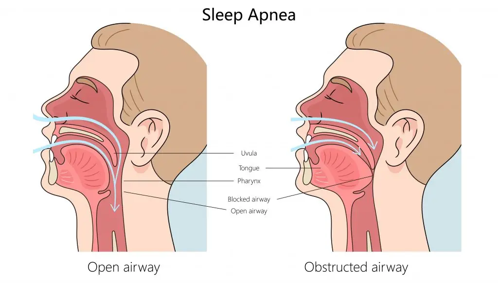 กรนแบบไหนอันตราย วิธีรักษานอนกรน กินยา ทำ RF เลเซอร์ เครื่อง CPAP ผ่าตัด