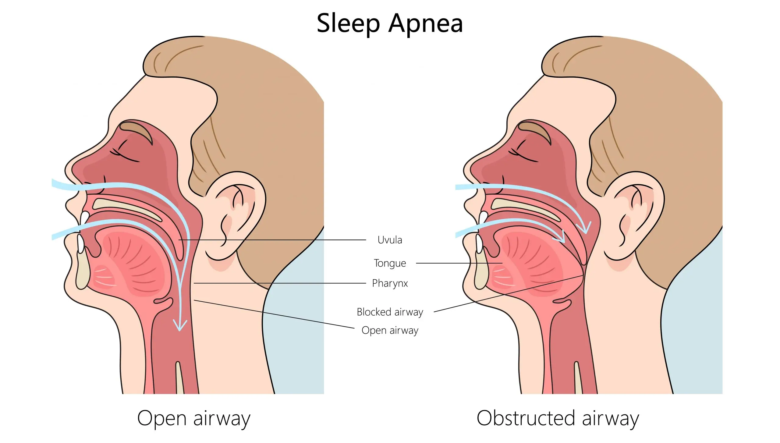 snoring sleep apnea treatment faq scaled