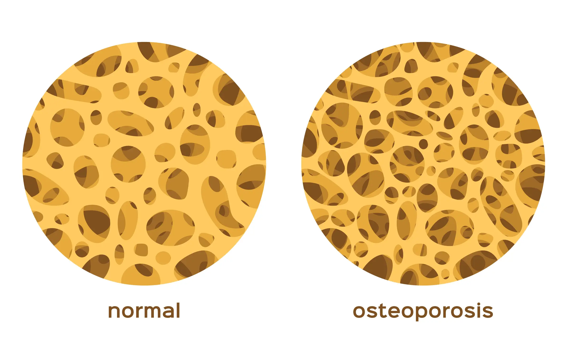 symptoms and causes of osteoporosis disease definition