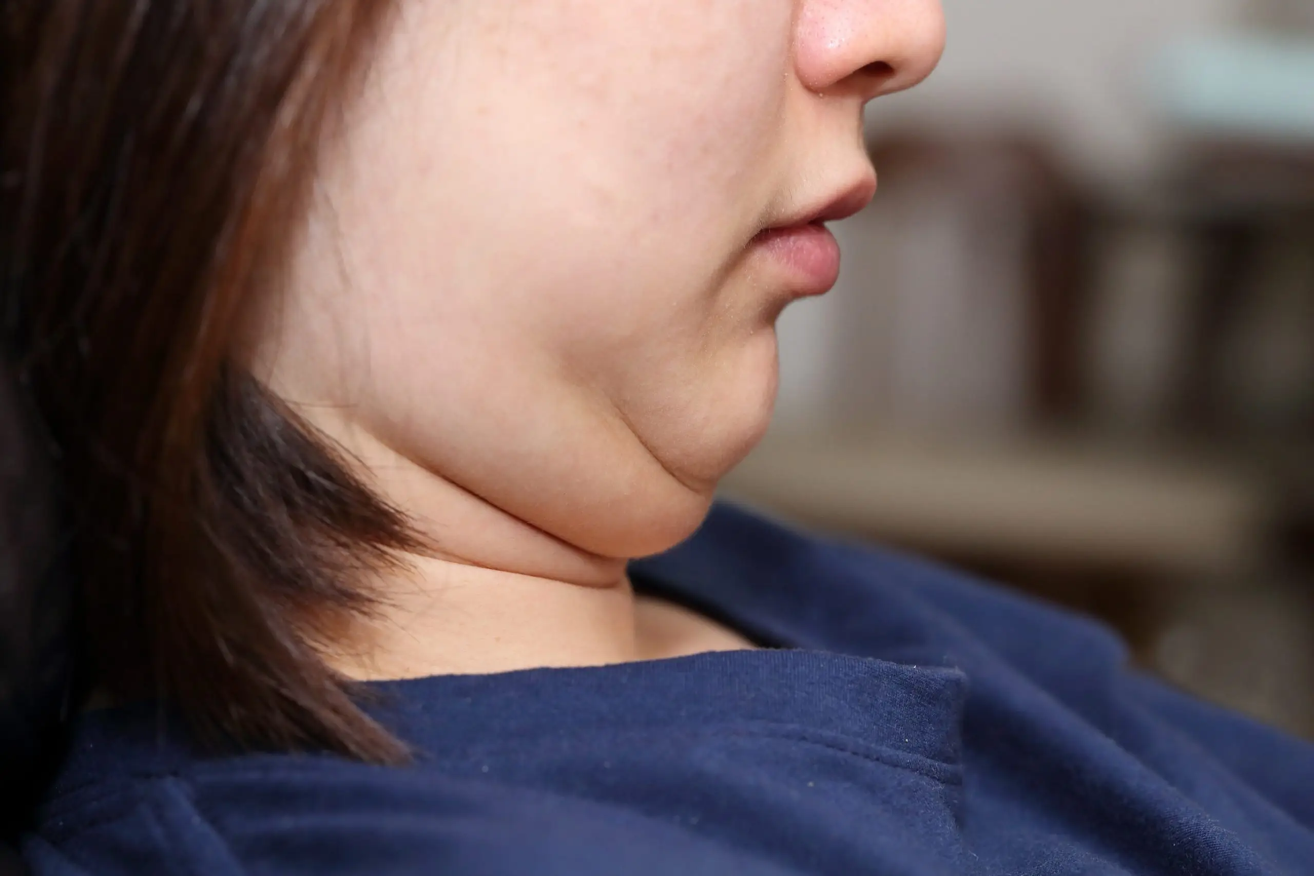 causes and how to get rid off double chin treatment how to scaled