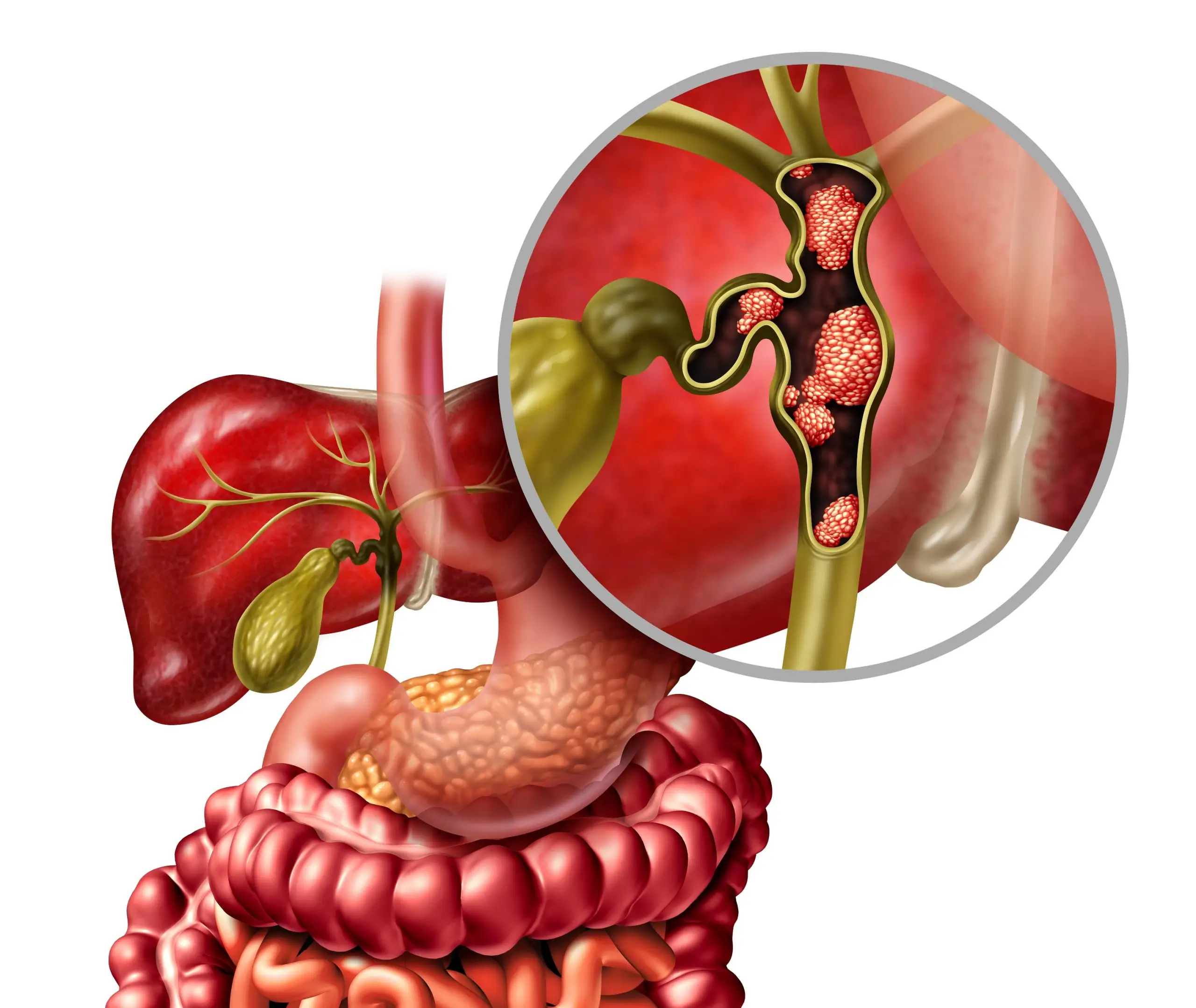 cholangiocarcinoma disease definition scaled