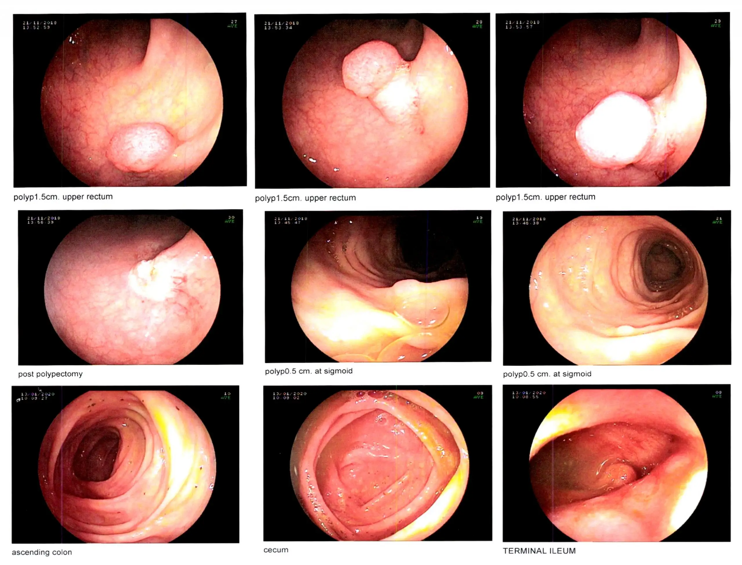 colonoscopy screening process scaled