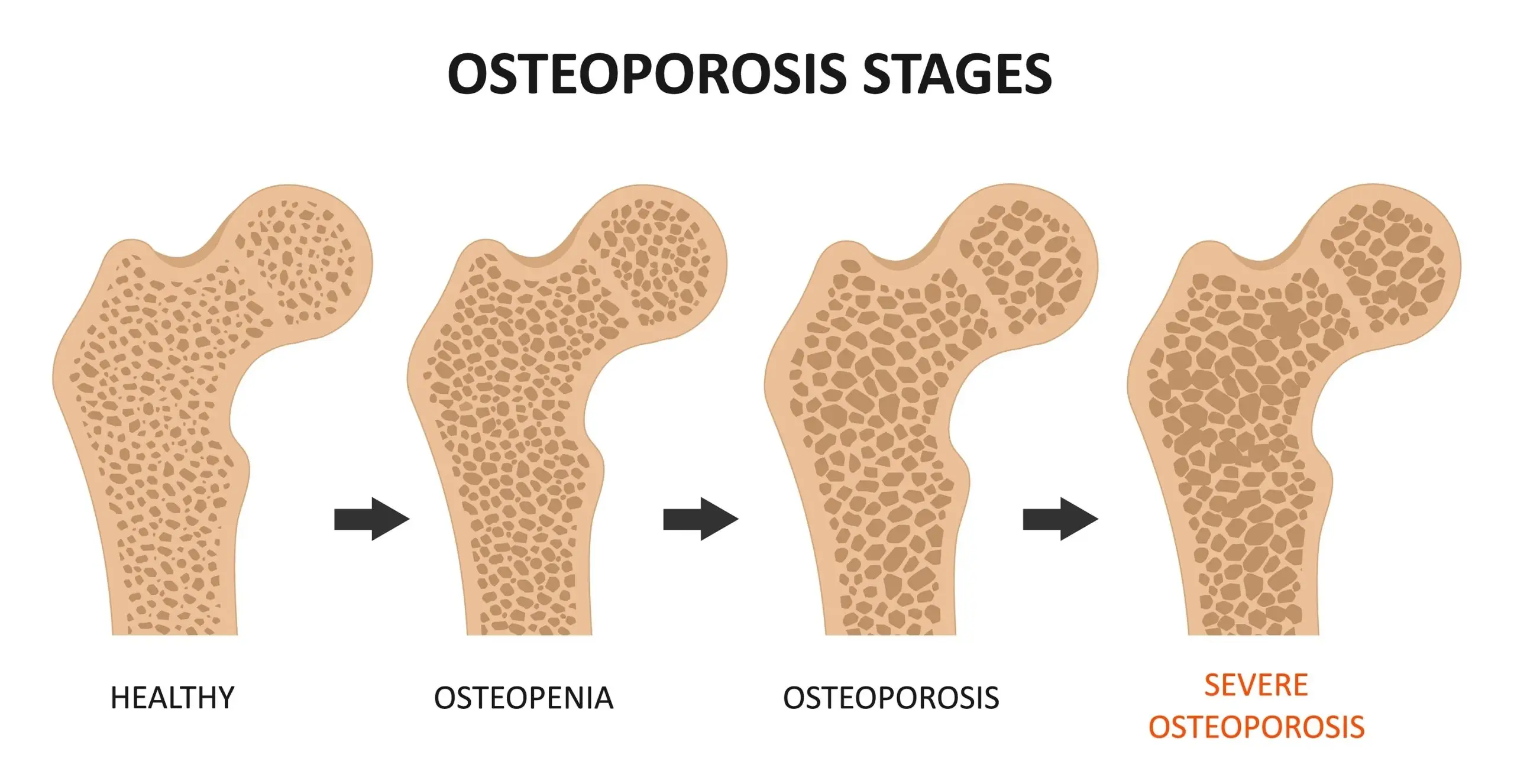 difference of osteoporosis and osteopenia disease definition scaled