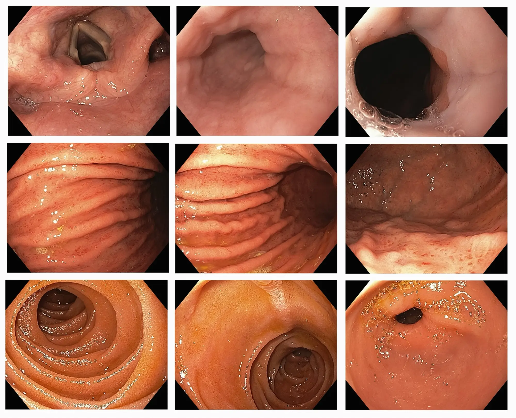 esophagogastroduodenoscopy screening process