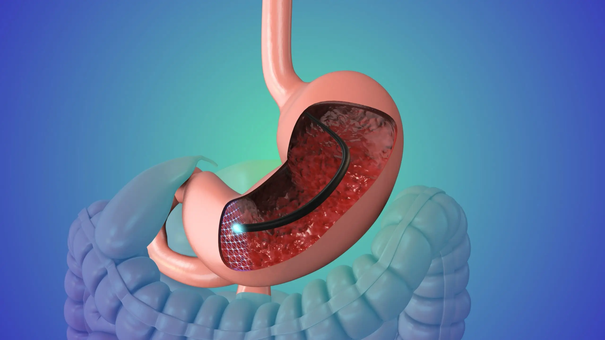 gastroscopy colonoscopy screening selfcheck scaled