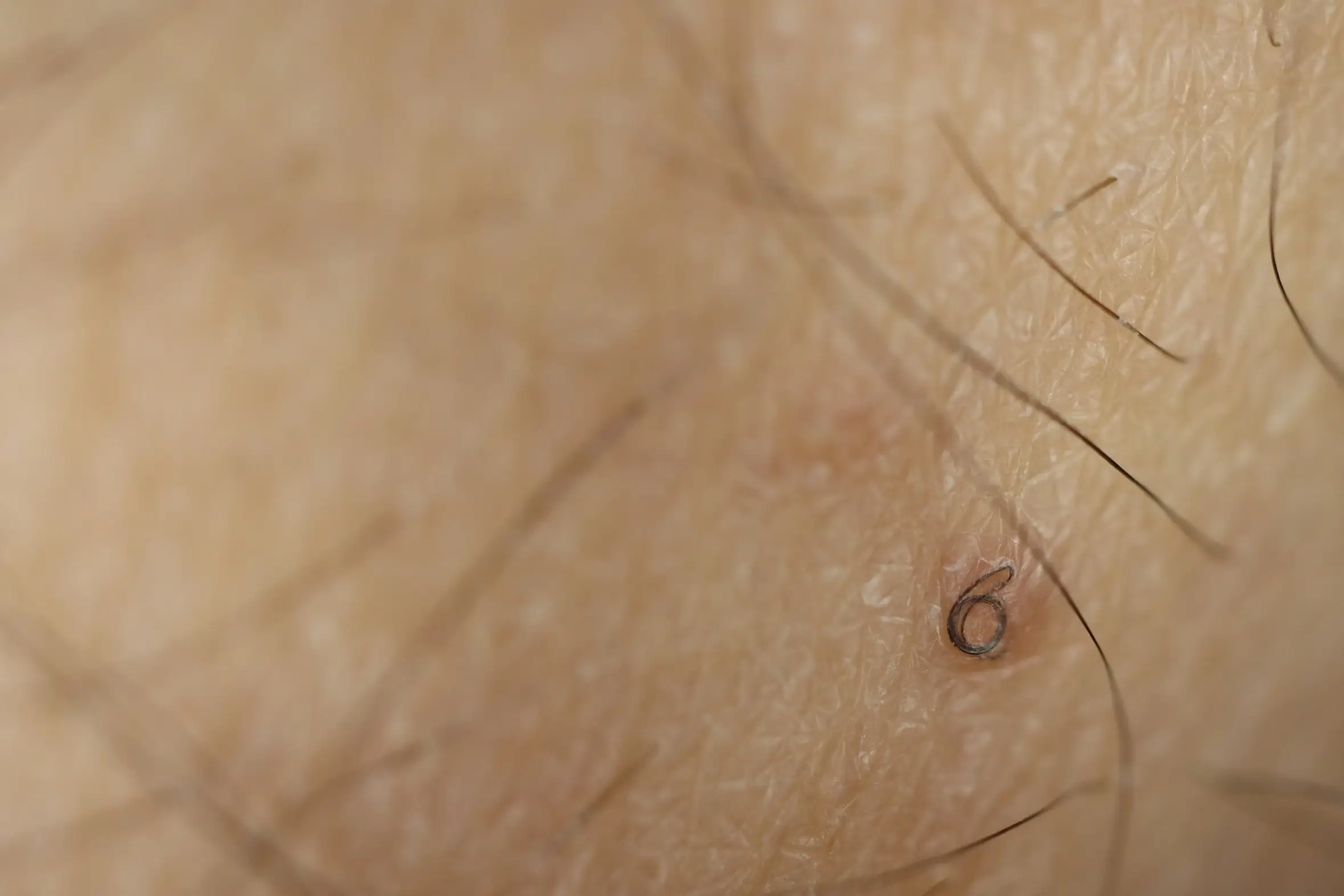 ingrown hair and how to cope disease definition