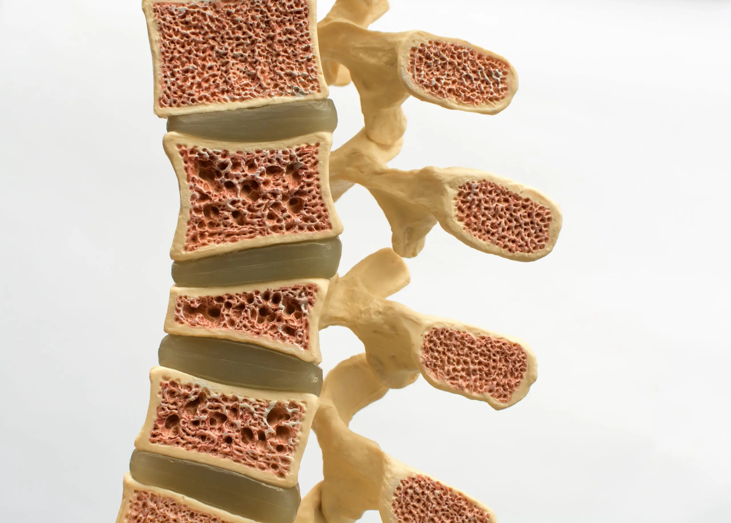 osteoporotic vertebral fracture disease definition scaled