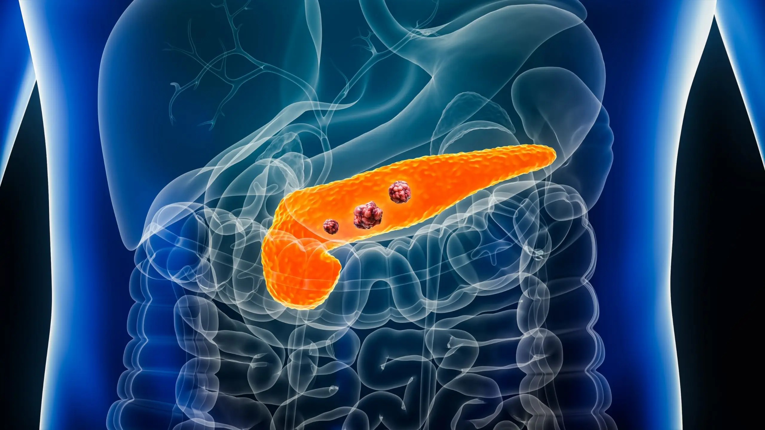 pancreatic cancer disease definition scaled