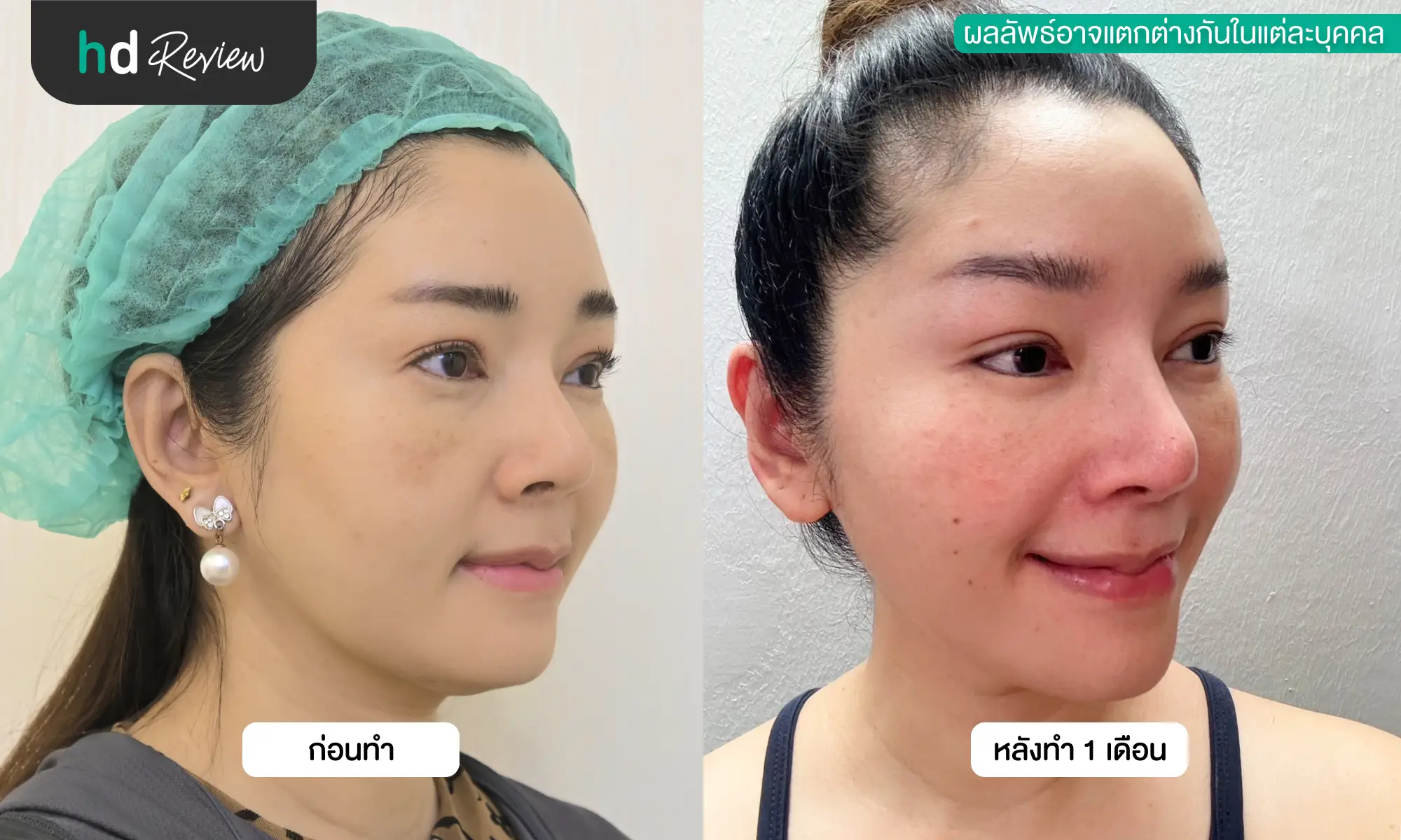 รีวิวผลลัพธ์หลังรักษาฝ้า ด้วยโปรแกรม SMAPS ที่ Chuladoctor Clinic