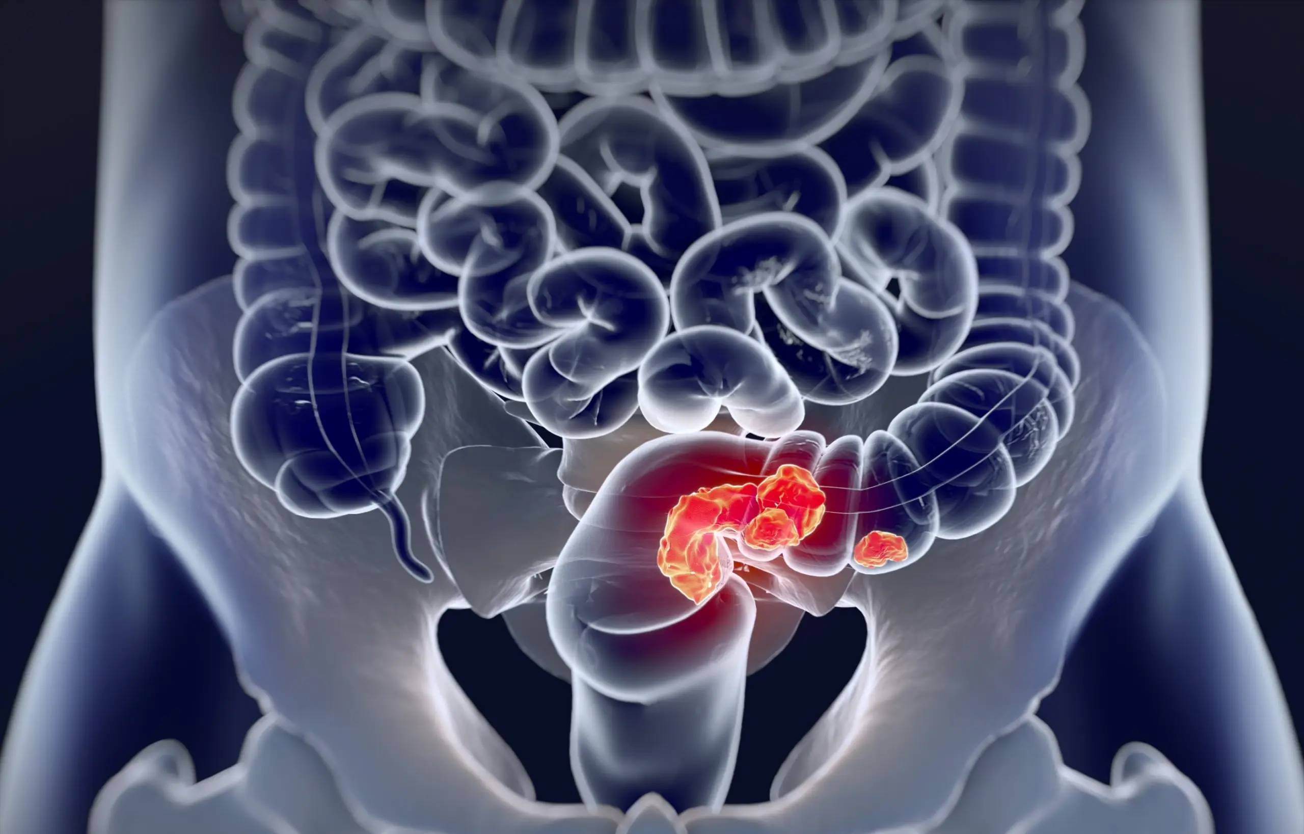 abdominal pain colon cancer disease definition scaled