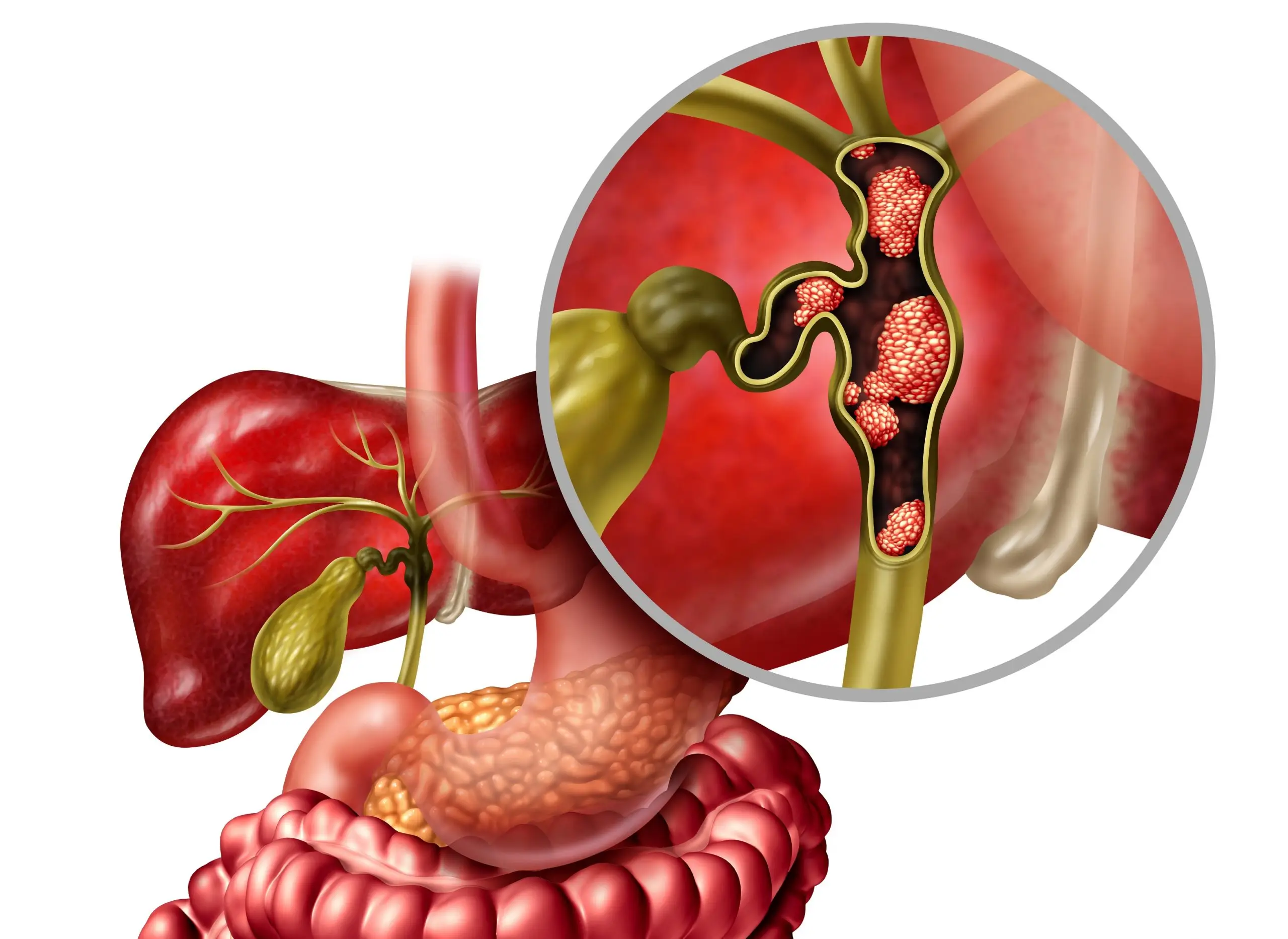 cholangiocarcinoma treatment process scaled