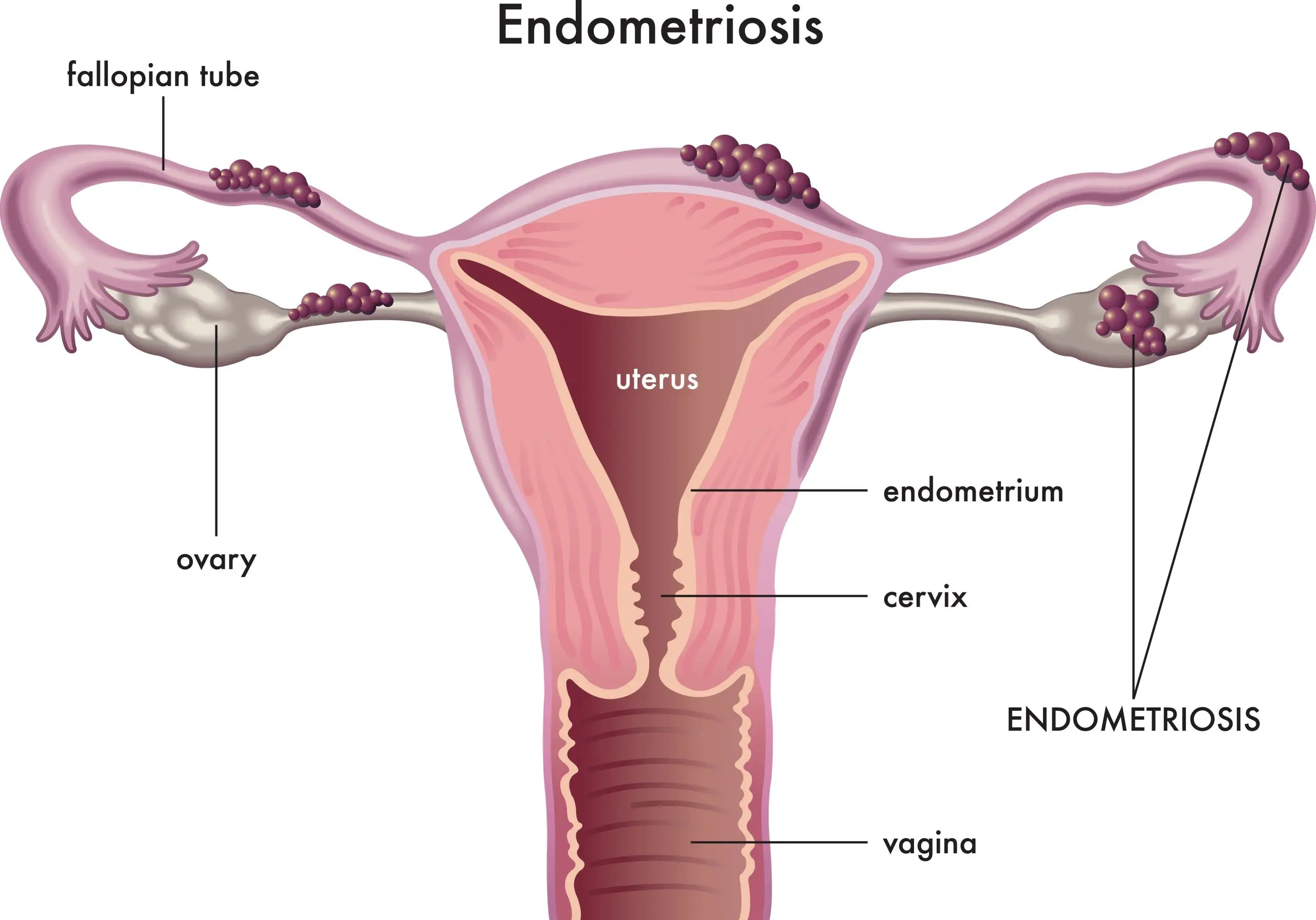 endometriosis disease definition scaled