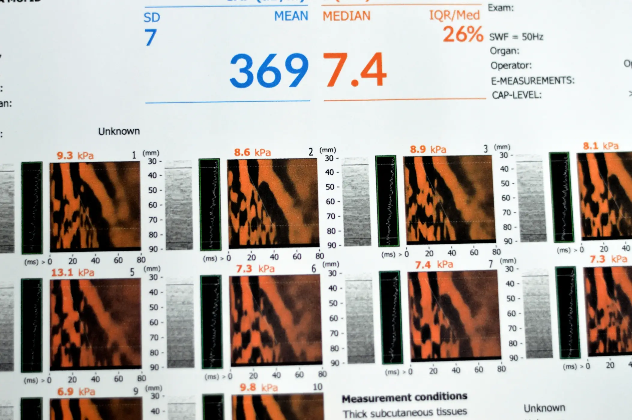 fibroscan for liver health screening process