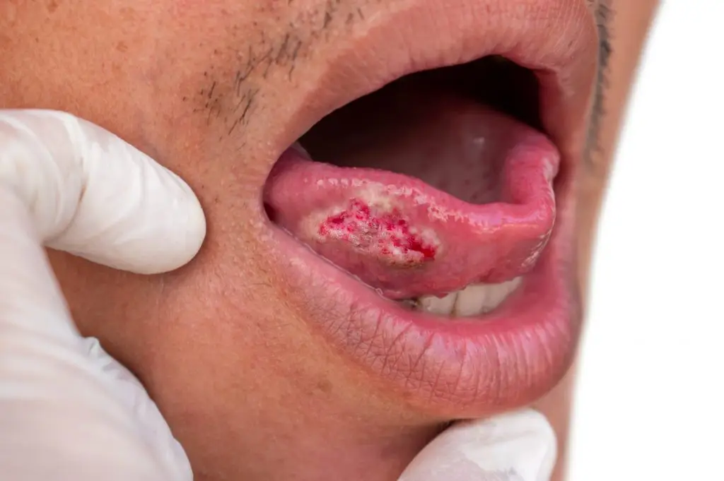 mouth cancer oral cancer