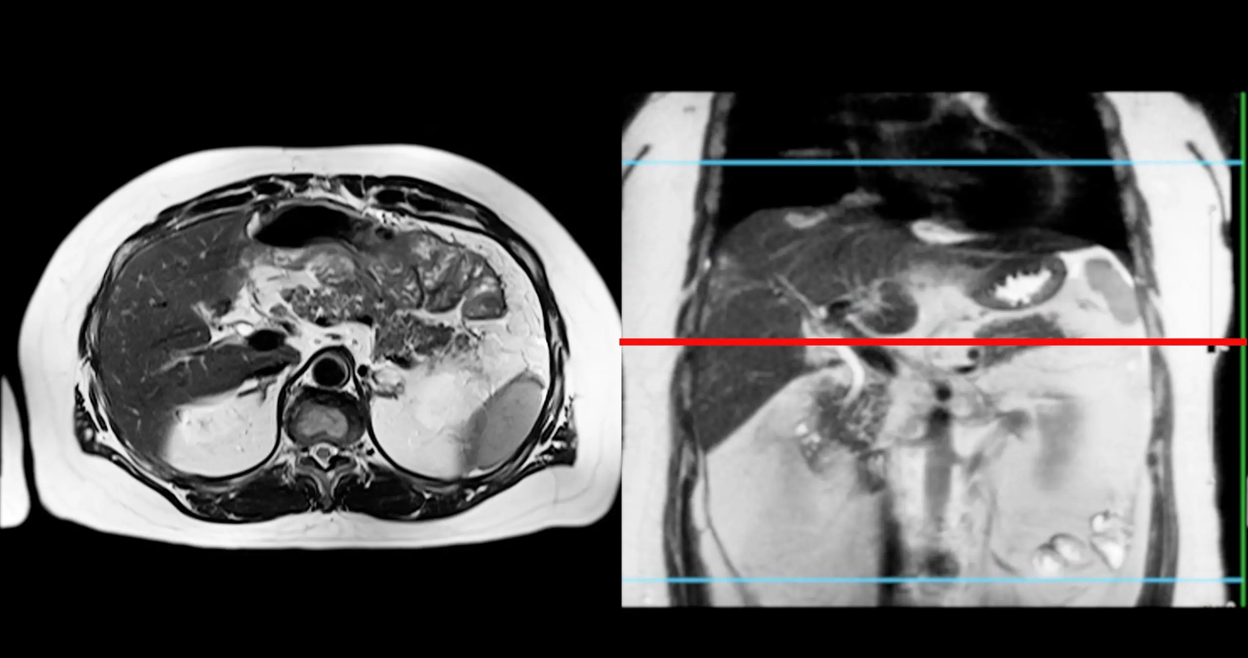 pancreas screening process scaled