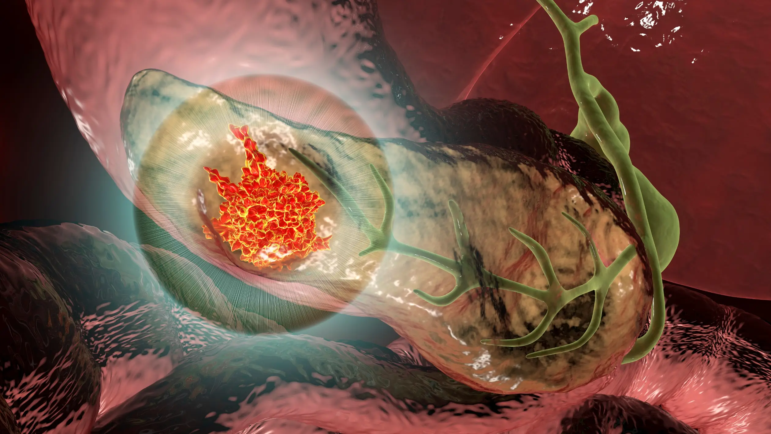 pancreatic cancer treatment process