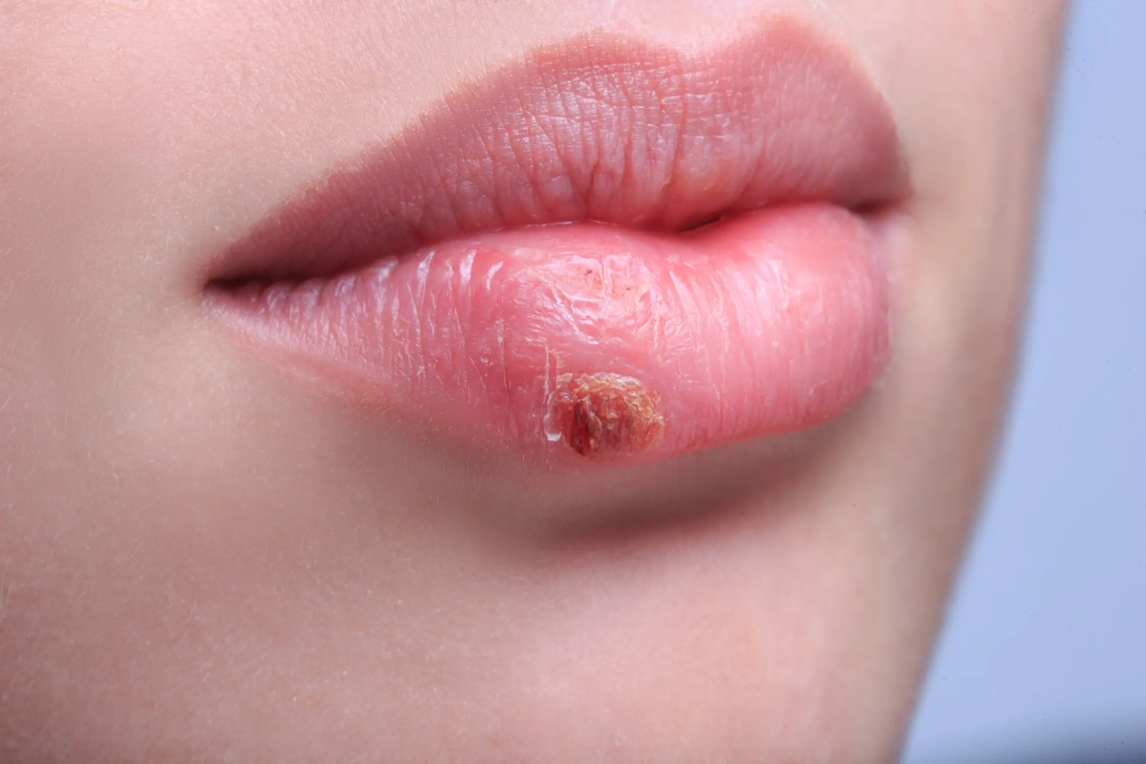 shingles vs herpes disease definition