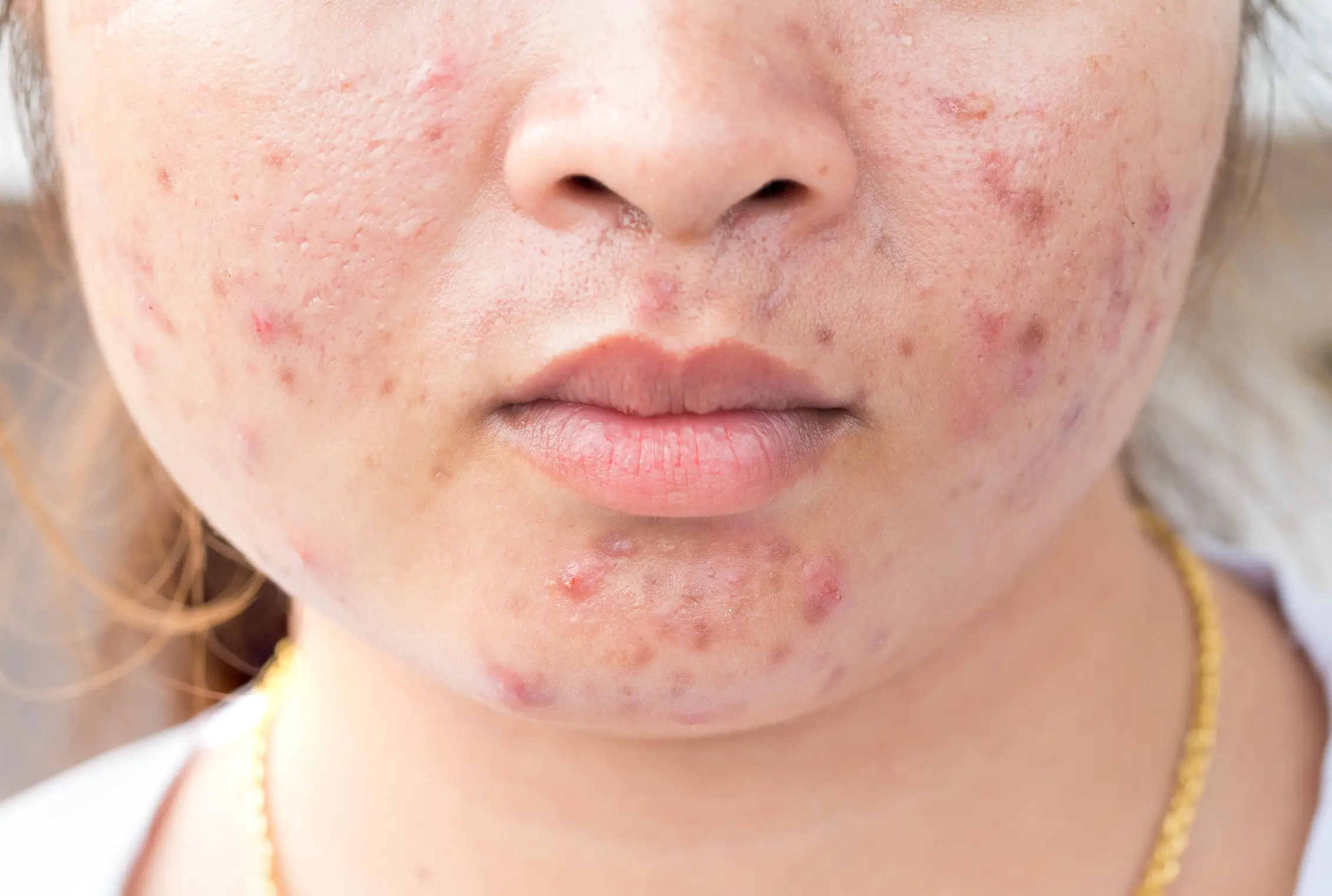 acne scar and how to treat it disease definition