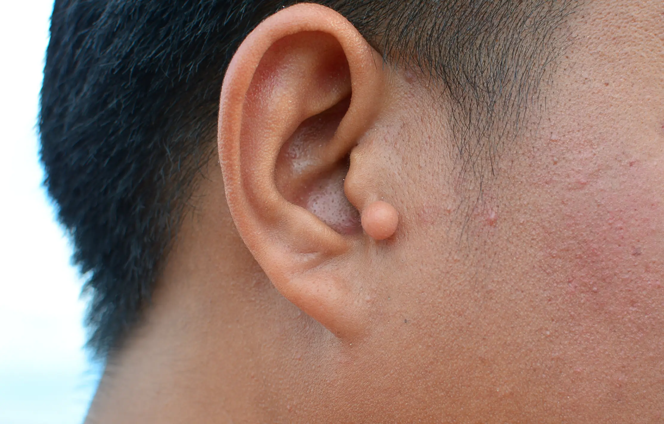 are keloid on ear dangerous disease definition