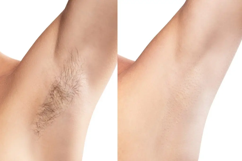 How to กำจัดขนรักแร้ (Armpit Hair Removal) แบบง่ายๆ ได้ผลจริง!