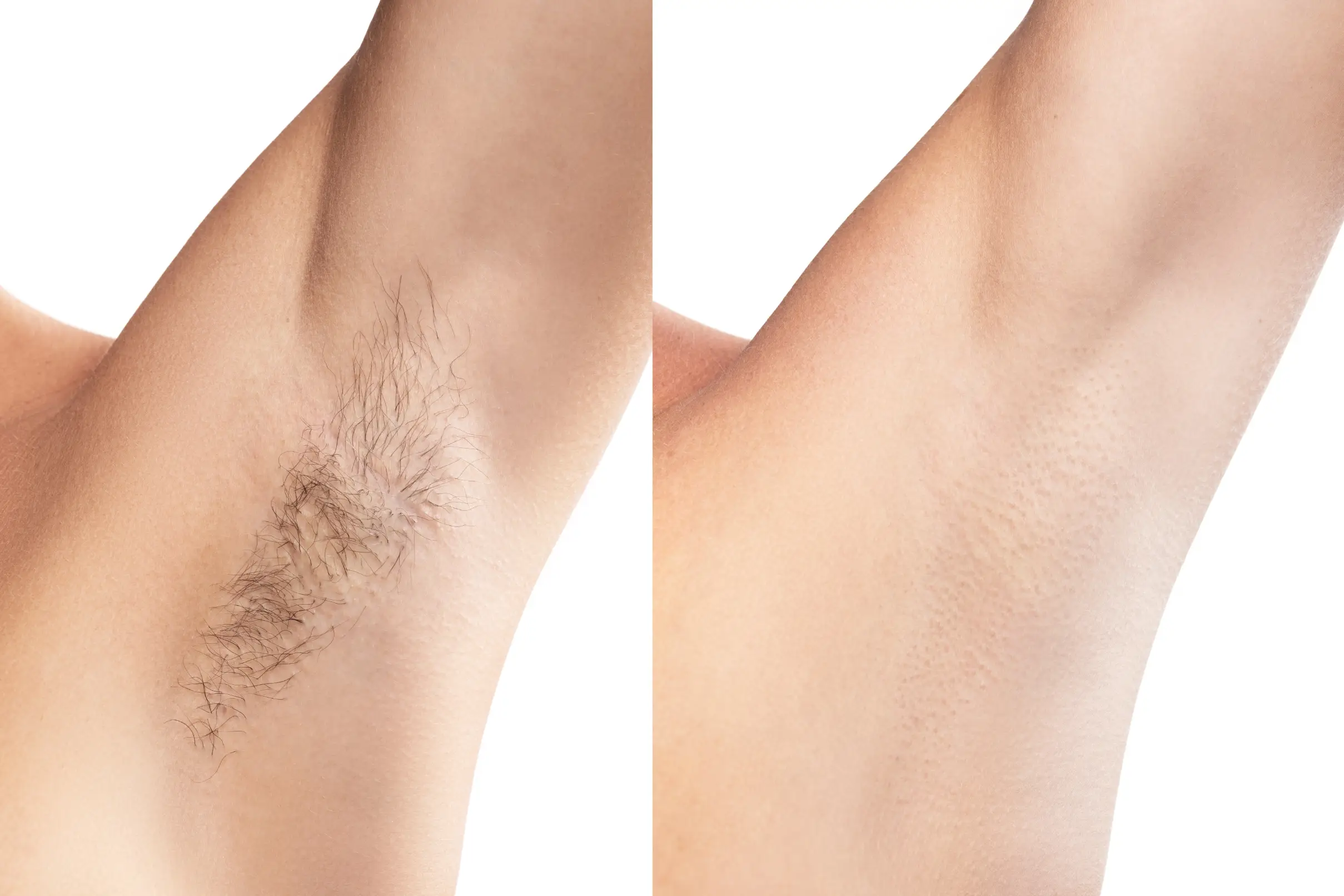 armpit hair removal treatment how to