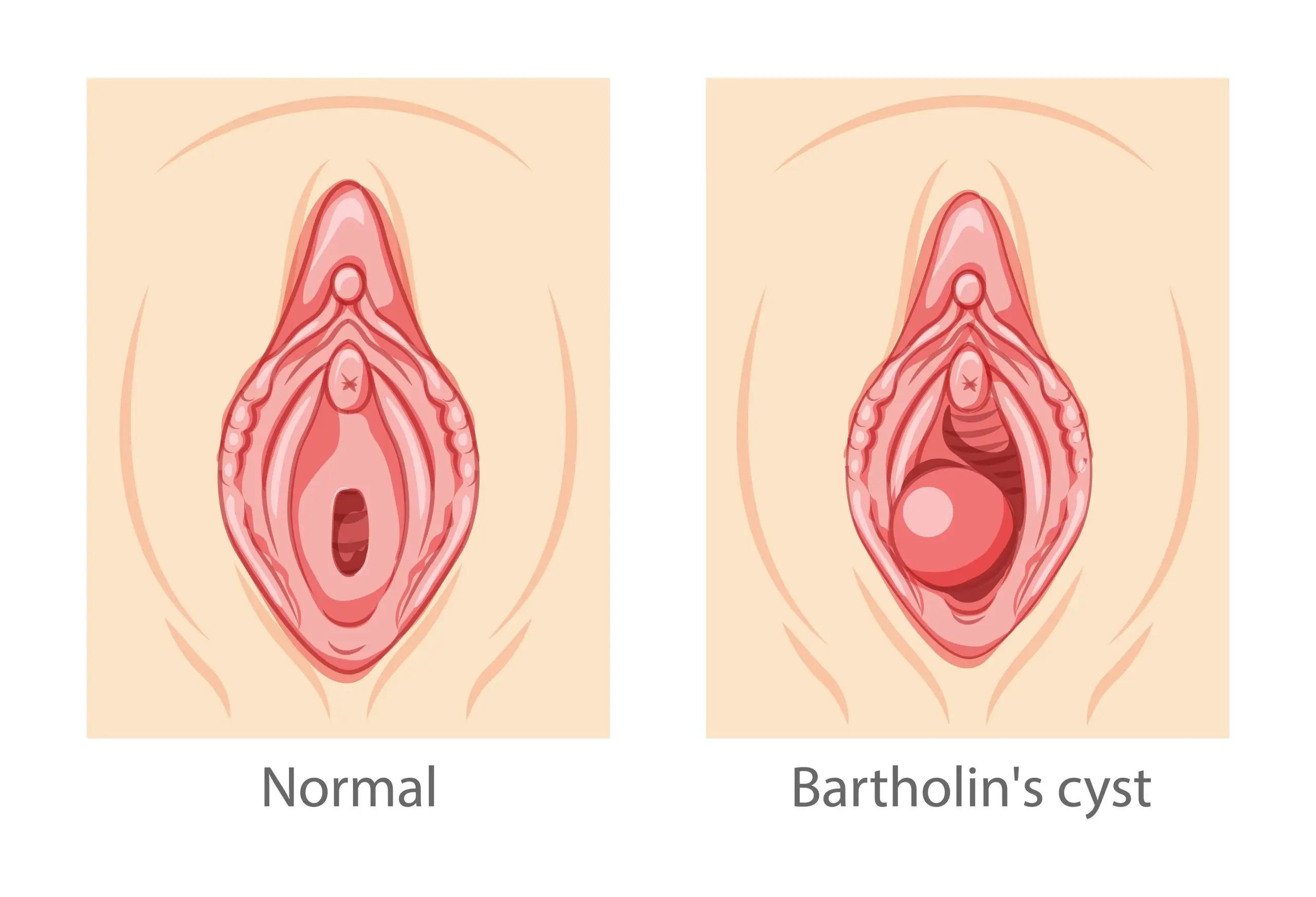 bartholin gland disease definition scaled