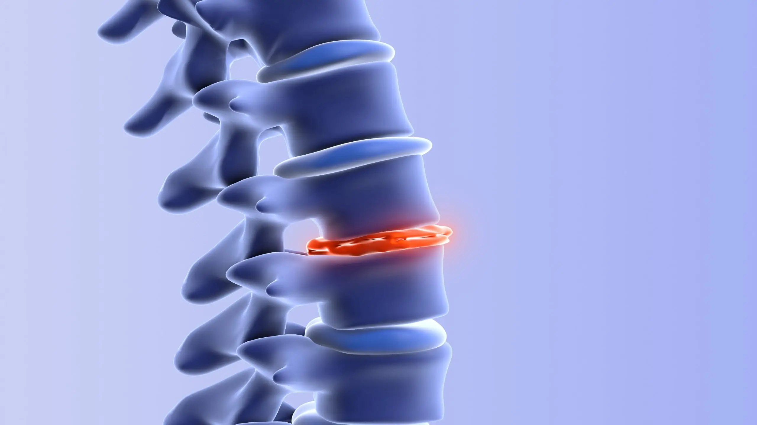 degenerative disc disease definition scaled