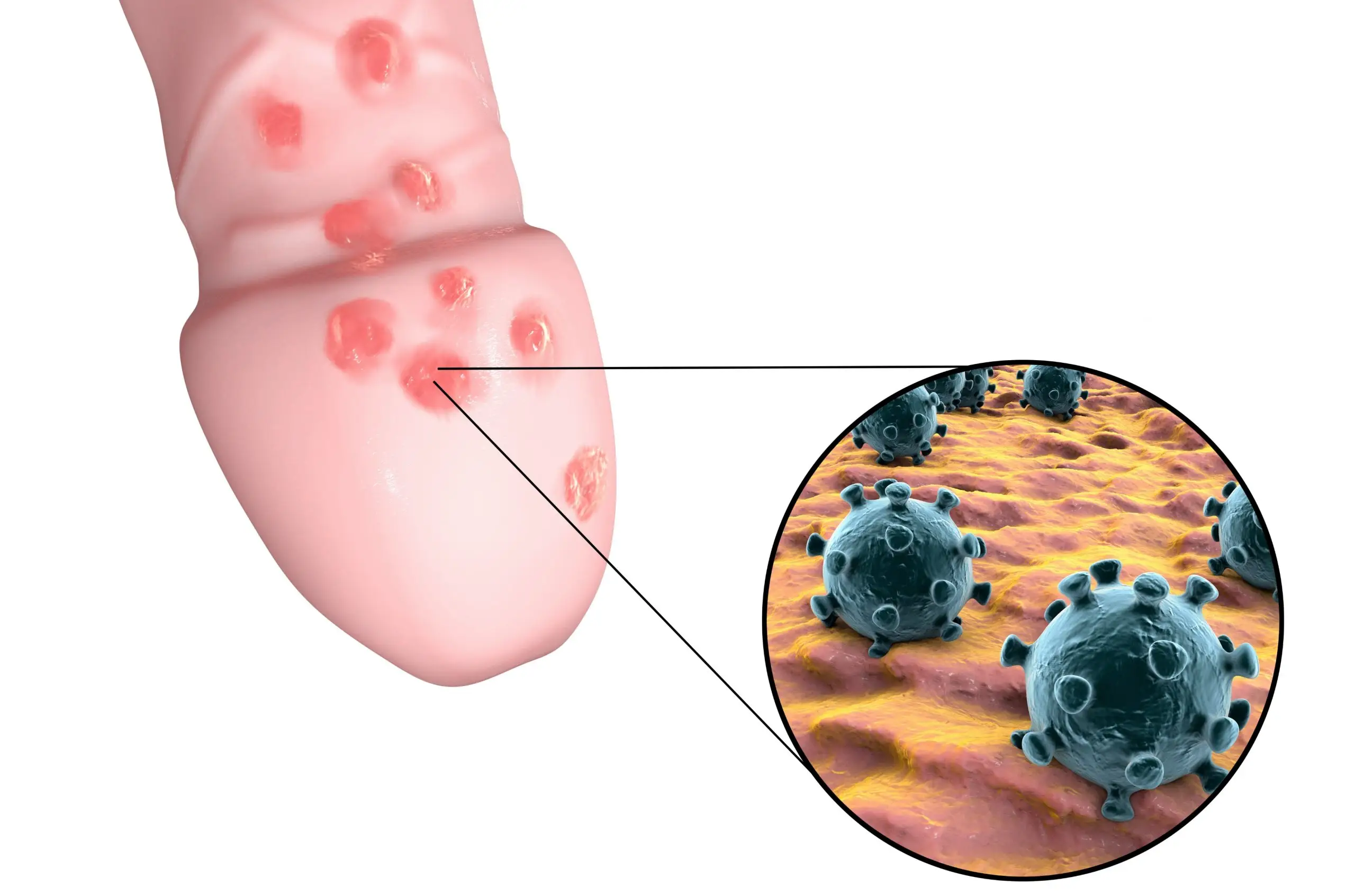 herpes genital disease definition scaled