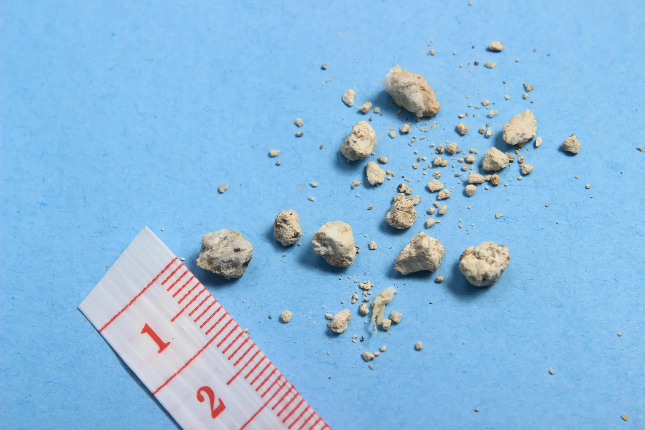 kidney stones disease definition