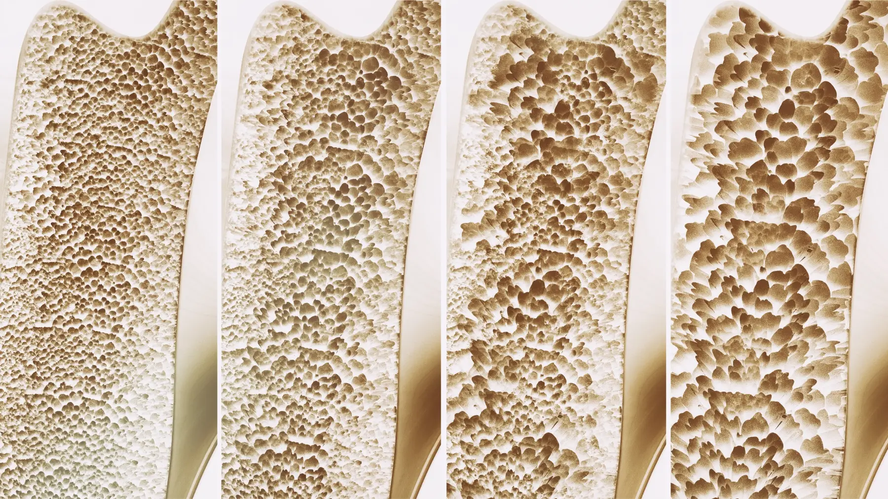 osteoporosis myths and facts disease misunderstanding