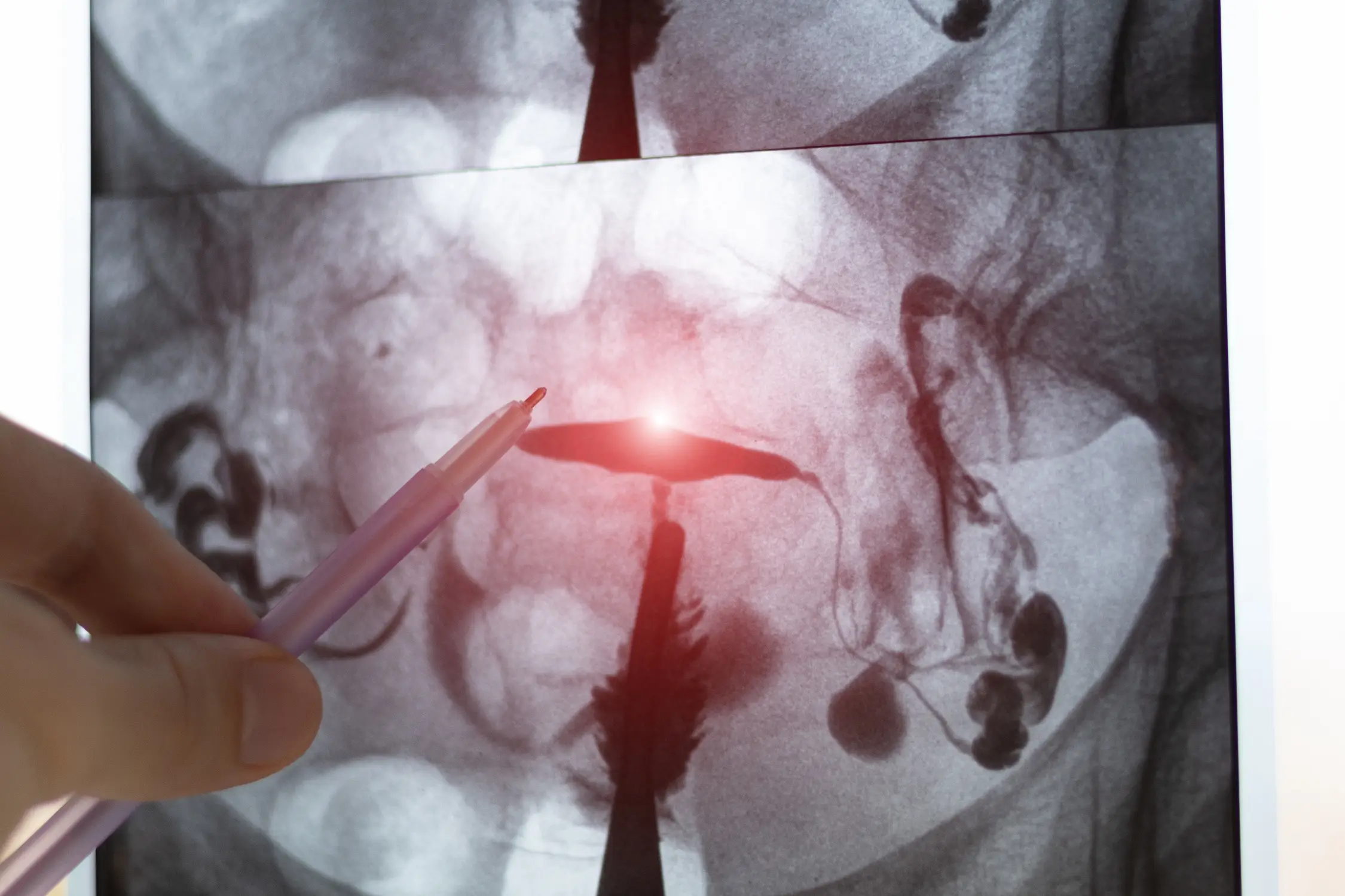 pelvis ct scan mri screening process