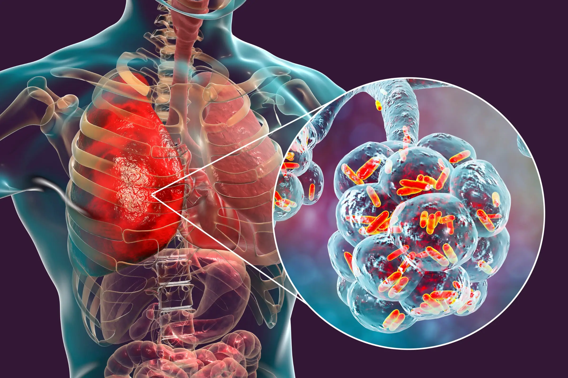 pneumonia disease definition