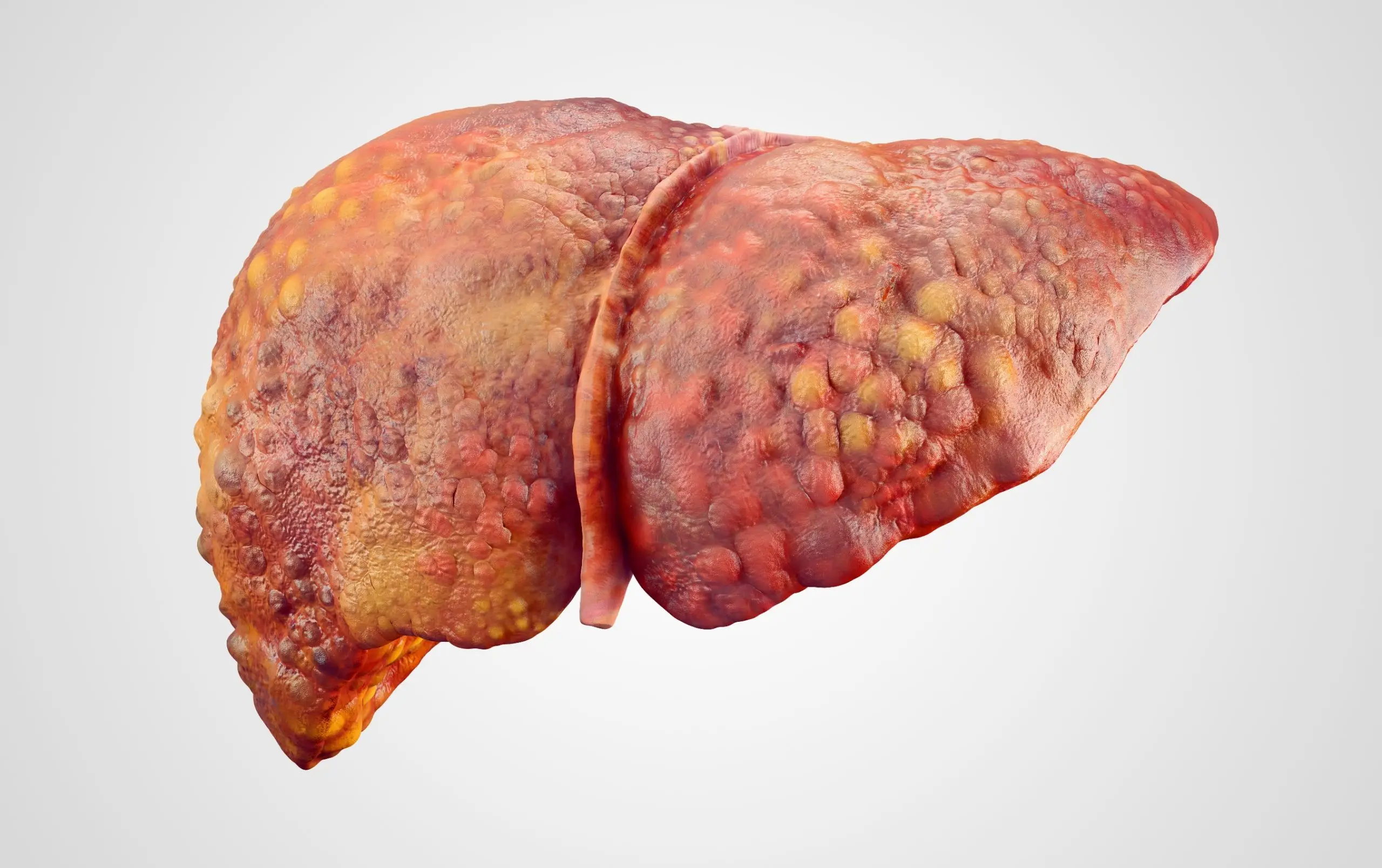 quick facts cirrhosis of the liver disease faq scaled